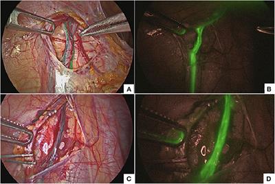 Image-Guided Pediatric Surgery Using Indocyanine Green (ICG) Fluorescence in Laparoscopic and Robotic Surgery